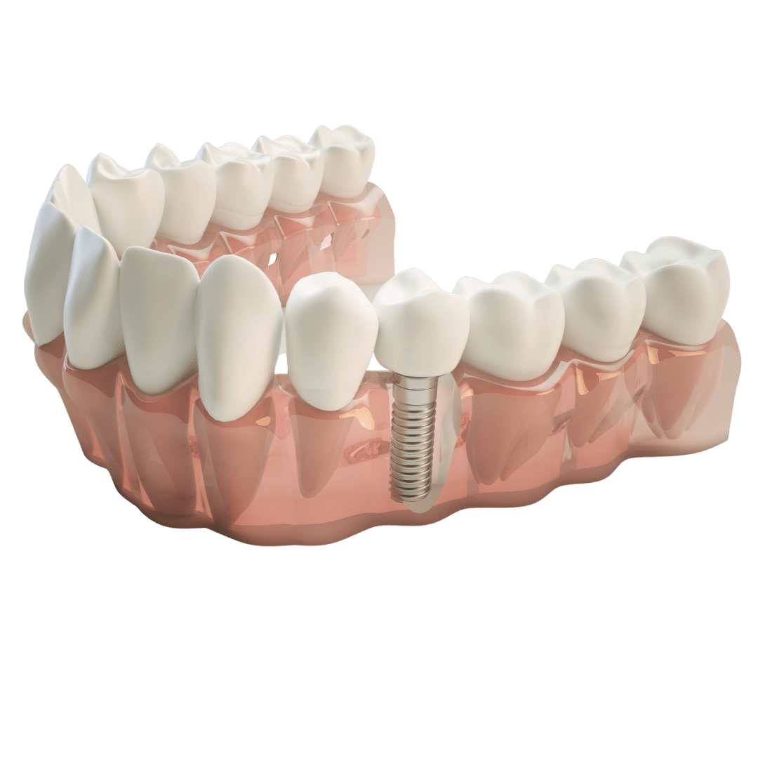 Dental Implants from 350 €