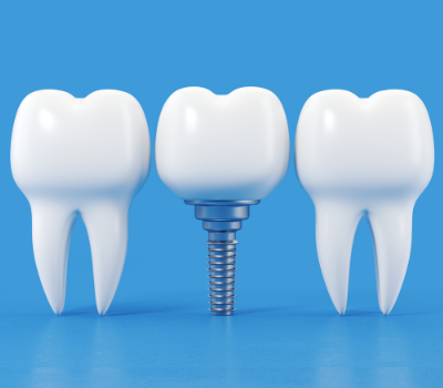 Dental Implants in Albania