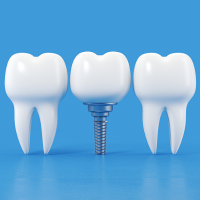 Dental Implants in Albania