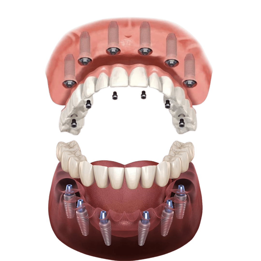 All mouth on 6 implantology 9000 €