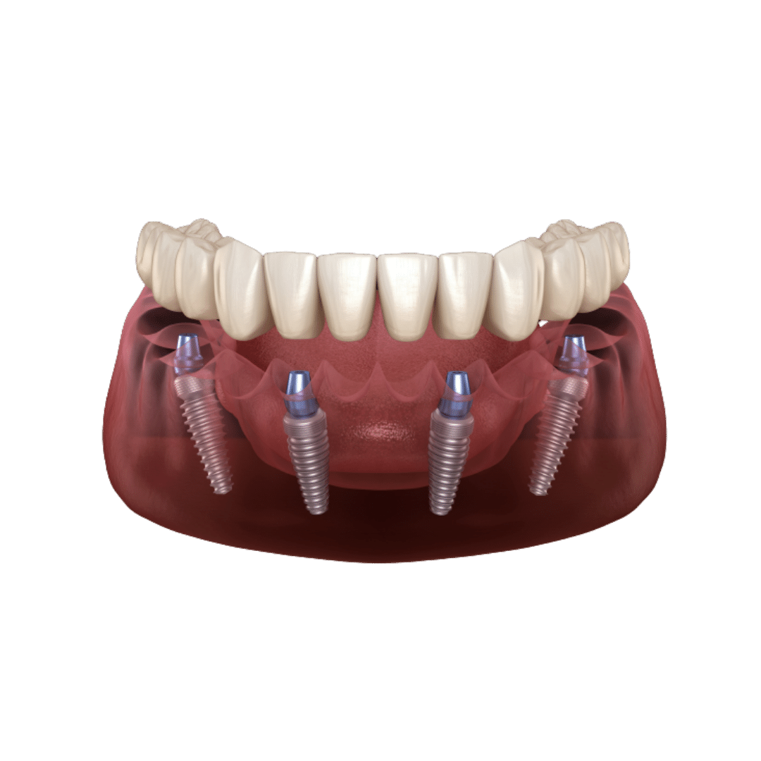 All on 4 implantology 3500 €